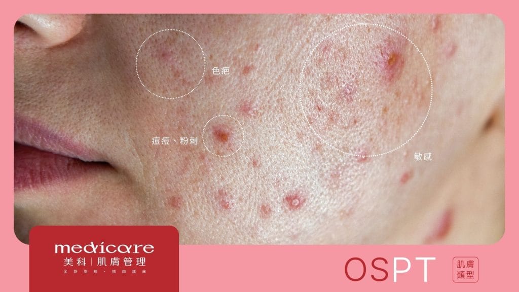 oil-sensitive-pigmented-tightness