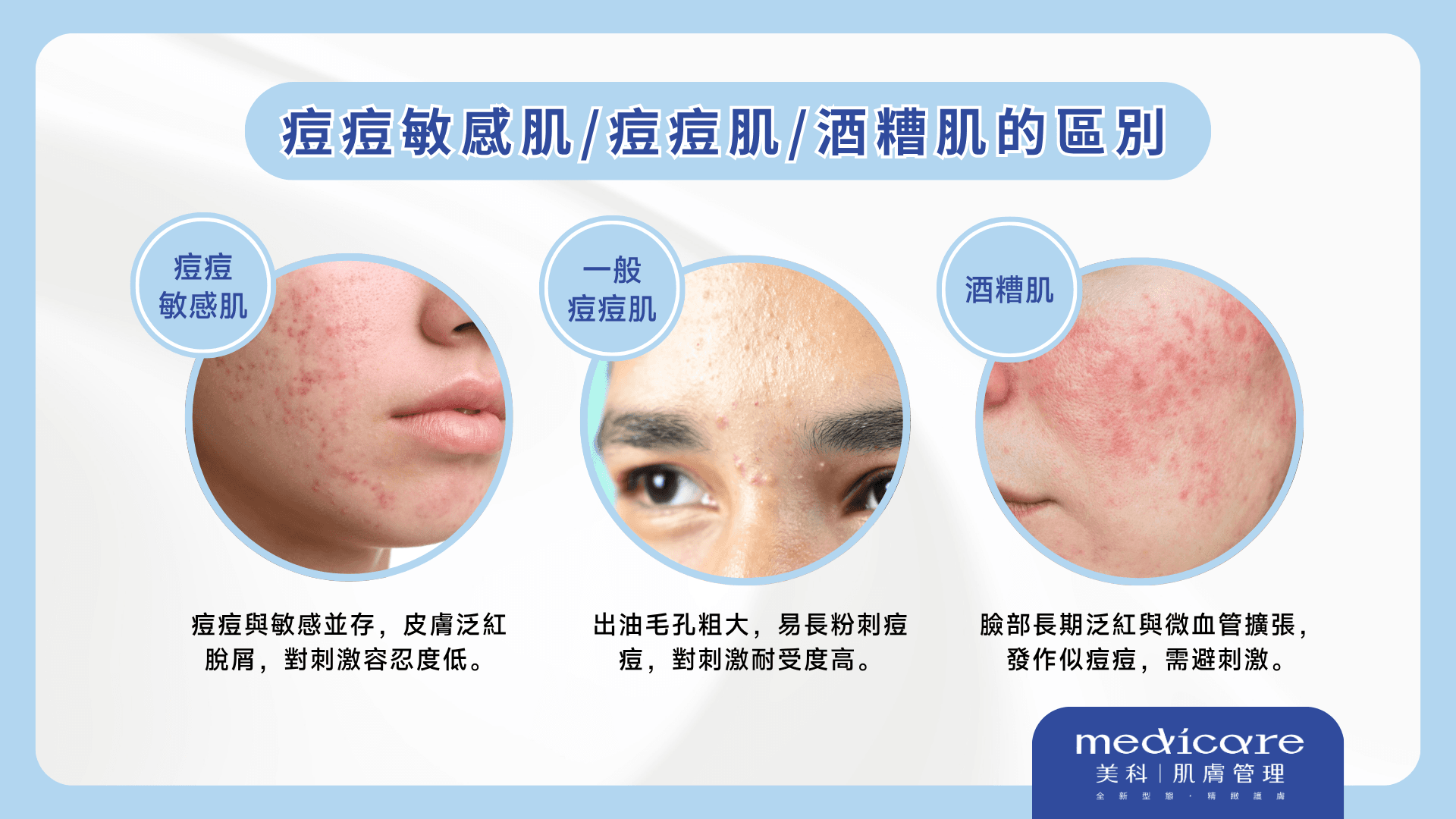 Differences Between Acne-Prone Skin, Acne-Prone Sensitive Skin, and Rosacea