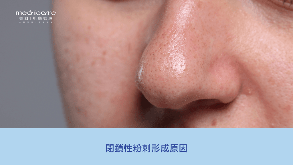 閉鎖性粉刺形成原因
