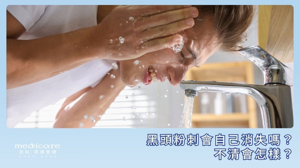 黑頭粉刺會自己消失嗎？
