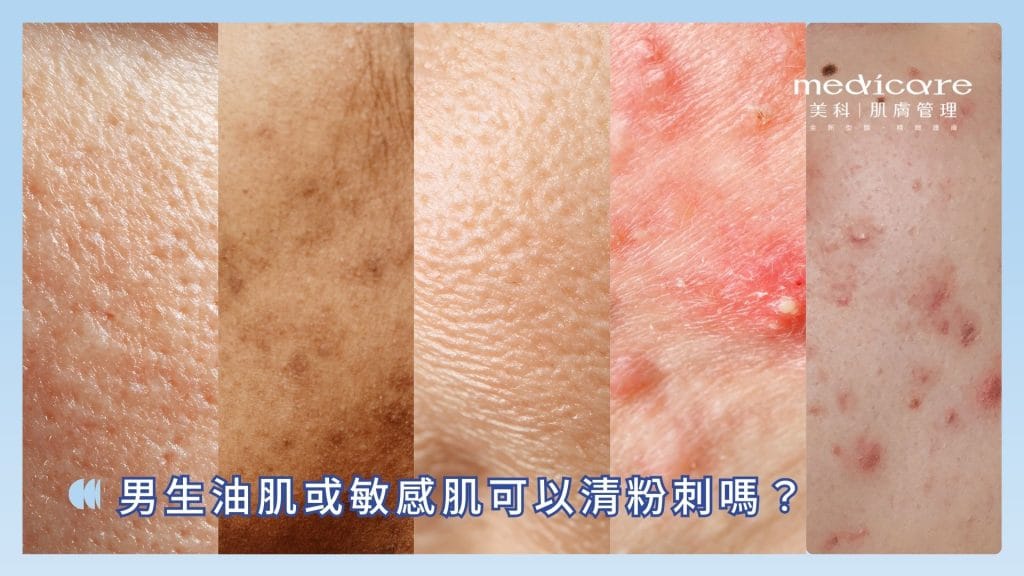 男生敏感肌可以清粉刺嗎？
