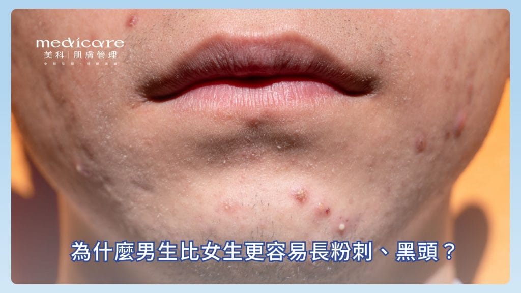 為什麼男生比女生更容易長粉刺、黑頭？