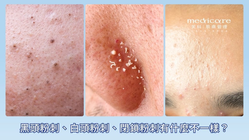 黑頭粉刺、白頭粉刺、閉鎖粉刺有什麼不一樣？