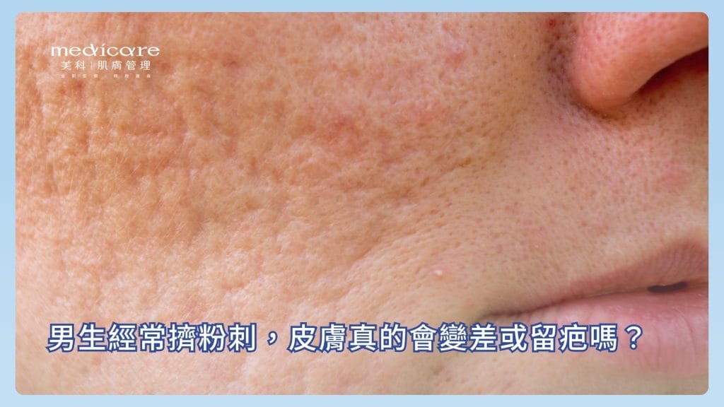 男生經常擠粉刺，皮膚真的會變差或留疤嗎？